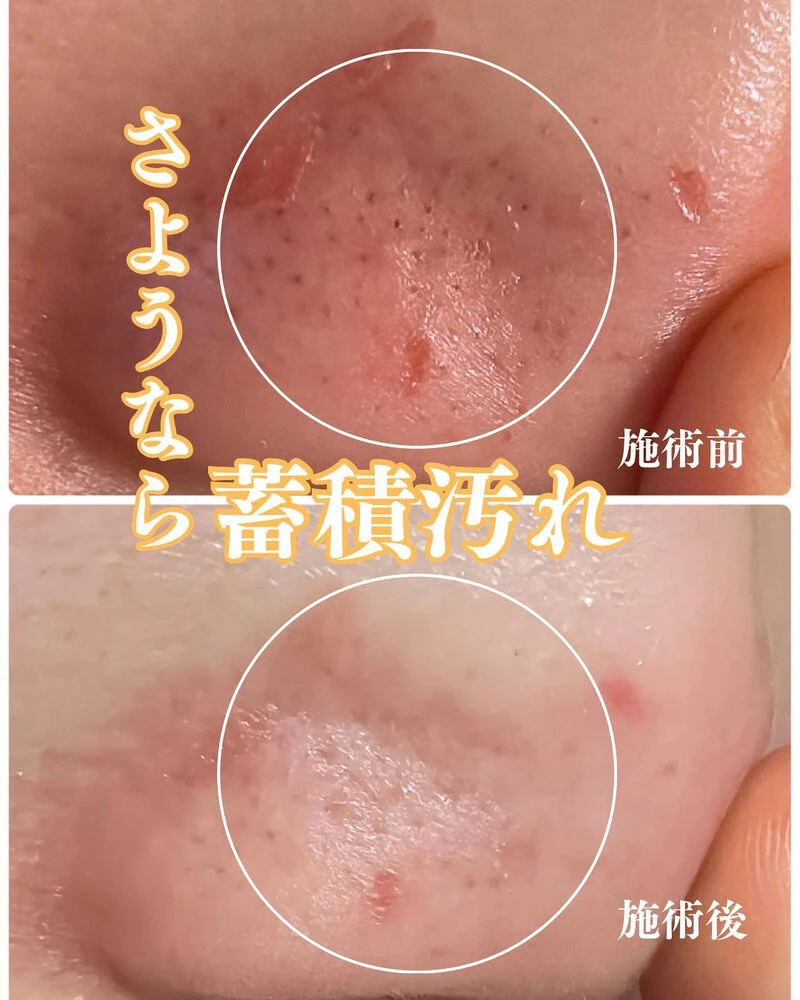 ブログ